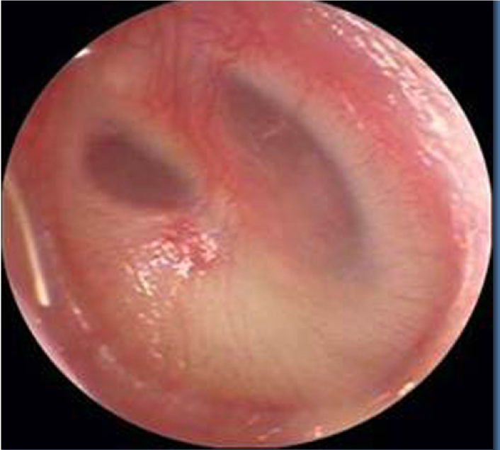 Acute Otitis Media With Perforation